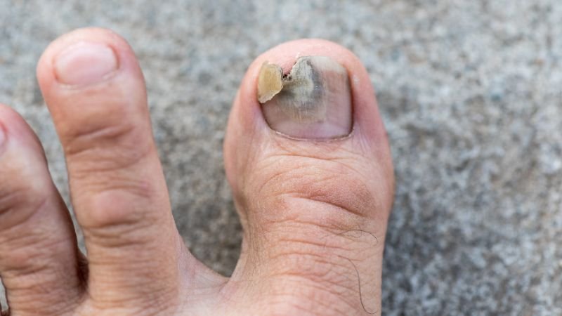 Micose nas unhas tratamento