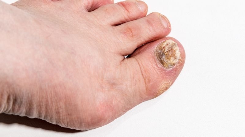 Tratamento de micose nas unhas