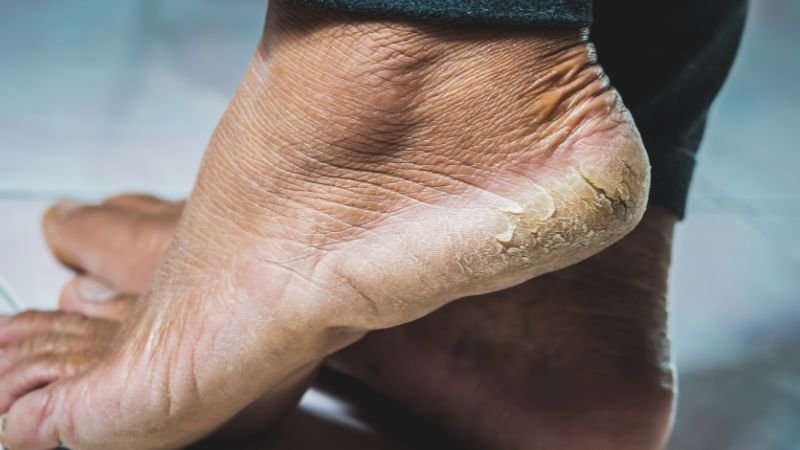 Tratamento de rachaduras nos pés